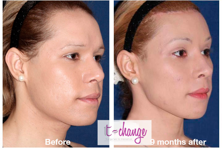 Facial Feminization Surgery Pictures 99