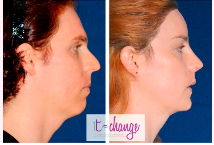 Facial Feminization Surgery Pictures 53