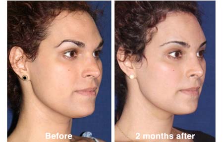 Feminization Facial Surgery 76