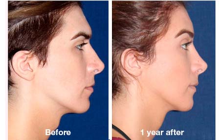 Facial Bone Surgery 22