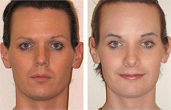Feminizacion Facial - Antes y despues 1