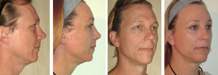 Feminizacion Facial - Antes y Despues 2