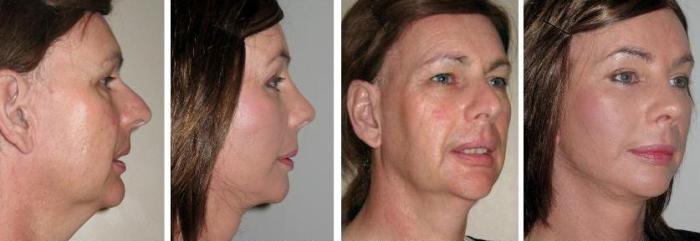 Feminizacion Facial. Antes y despues 2