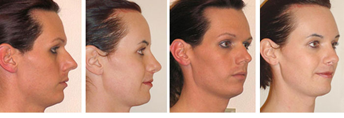 Facial Femenization. Before and 1 month after