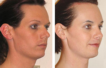 Facial Femenization. Before and 1 month after