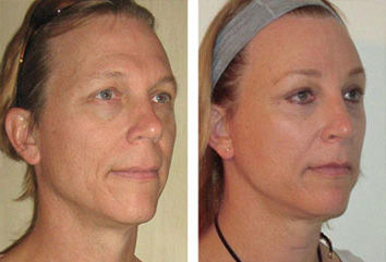 Facial Femenization. Before and after 2.