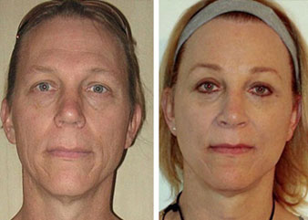 Facial Femenization. Before and 6 months after.