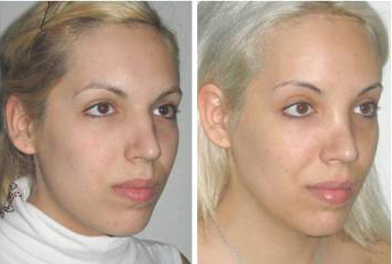 Partial Facial Feminization Surgery (just forehead and nose)