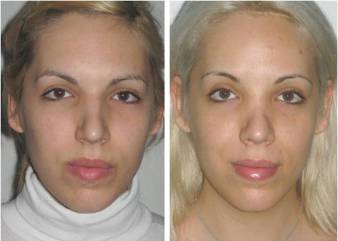 Facial Femenization. Before surgery and 3 years after it.