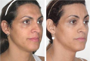 Facial Femenization. Facial Feminization Surgery (just forehead and nose).