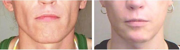 reduction with face and neck lift