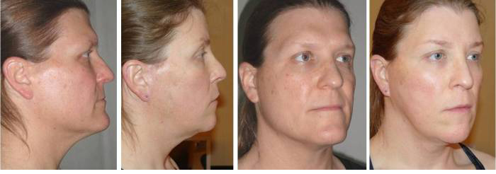 Facial Femenization. Before and 1 month after