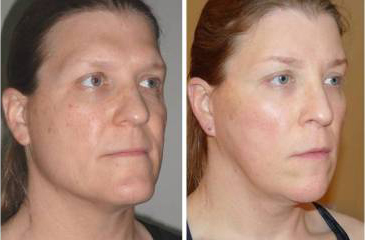 Facial Femenization. Before and 1 month after