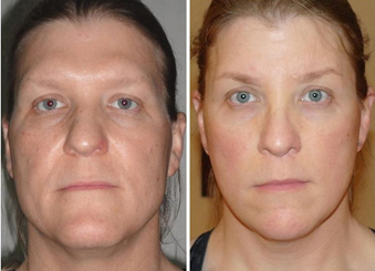 Facial Femenization. Before and after 1