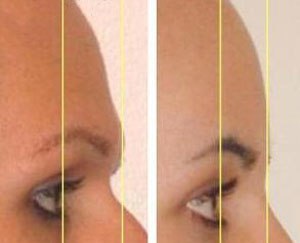 forehead contouring reconstruction