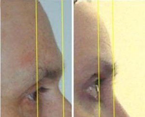 forehead contouring reconstruction