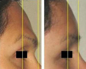 forehead contouring reconstruction