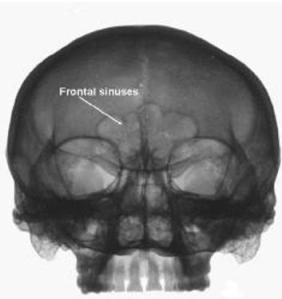 frontal sinuses