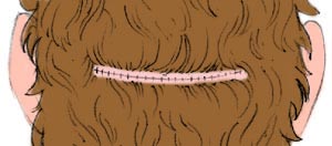 hair transplants hair transplants