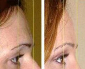 forehead