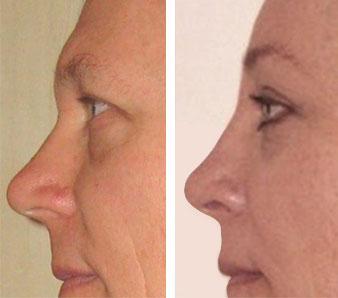 Rhinoplasty with forehead reconstruction