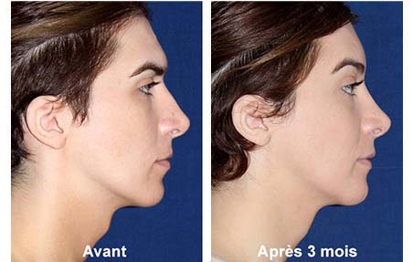 cirurgia de feminização facial