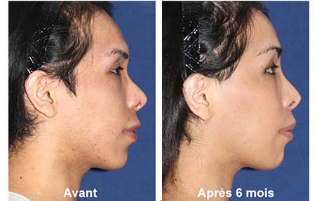 cirurgia de feminização facial