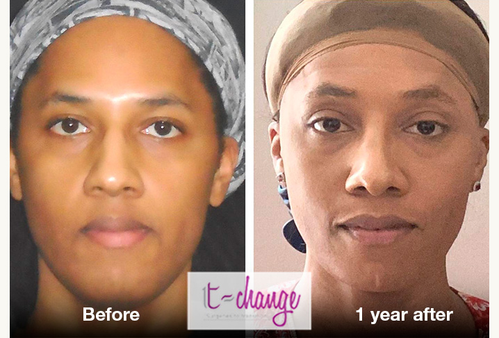 Facial Feminization Surgery before and after - FFS Pictures