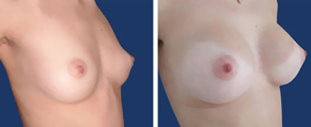 Body Procedures: Breast Augmentation
