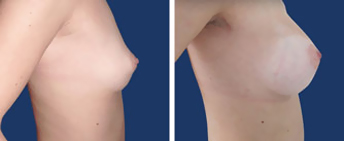 Body Procedures: Breast Augmentation