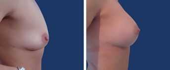 Body Procedures: Breast Augmentation