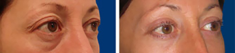 Blefaroplastia