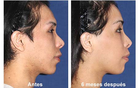 cirugia de feminizacion facial