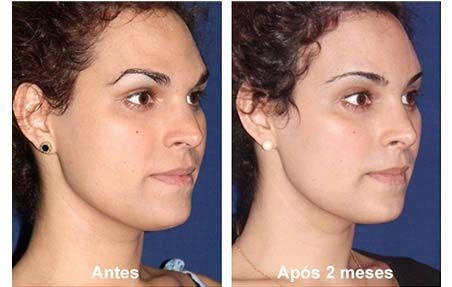 cirugia de feminizacion facial