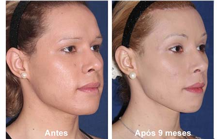 cirugia de feminizacion facial