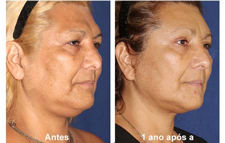 cirugia de feminizacion facial