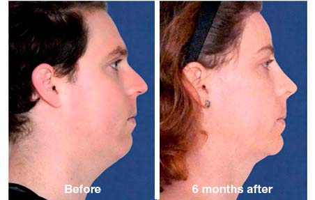 facial feminization surgery