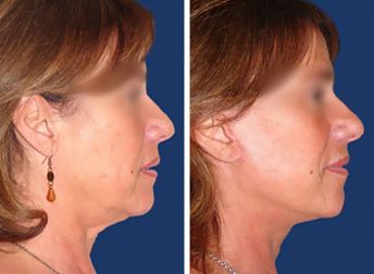 Face lift (Rhytidectomy)