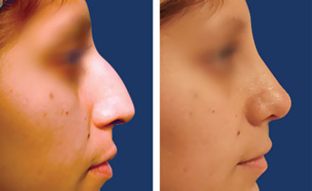 Rhinoplasty