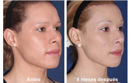 cirugia de feminizacion facial