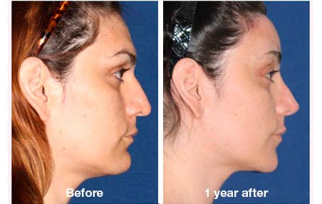 facial feminization surgery