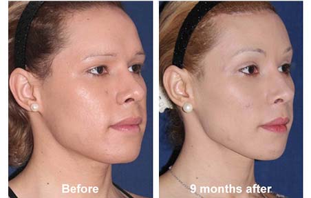 facial feminization surgery