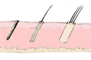 Hair Transplant by follicular micrografting