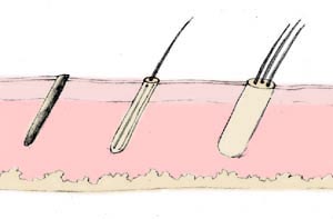 Trasplante capilar microfolicular