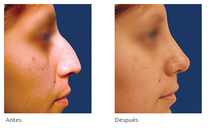 cirugia de feminizacion facial