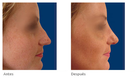 cirugia de feminizacion facial