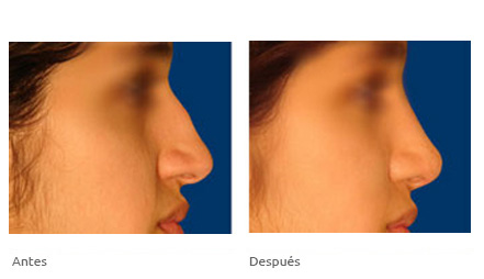 cirugia de feminizacion facial