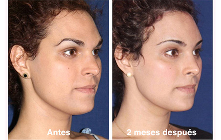 cirugia de feminizacion facial
